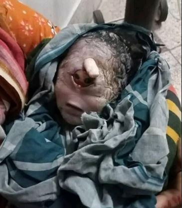 গাইবান্ধার রাবেয়া ক্লিনিকে 'আজব' শিশুর জন্ম:  চাঞ্চল্যের সৃষ...