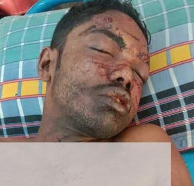 যশোরে বোমা বিস্ফোরনে বিএনপি কর্মী গুরুতর আহত